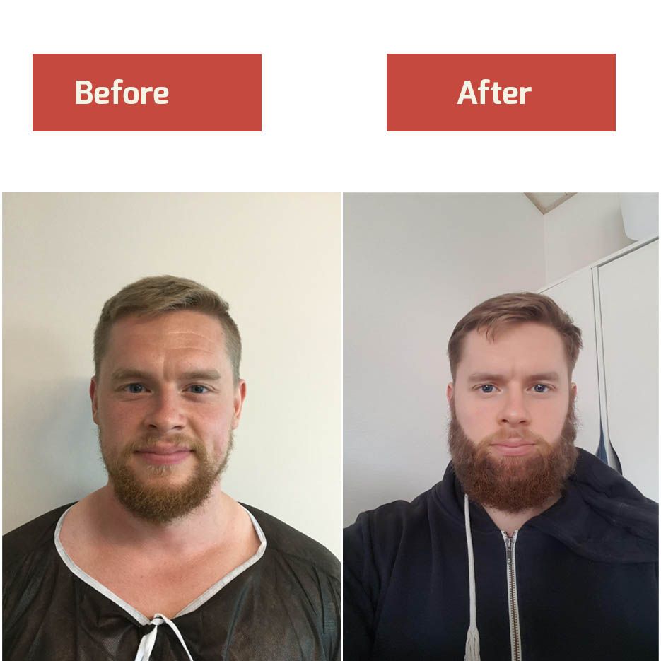 Beard Transplant