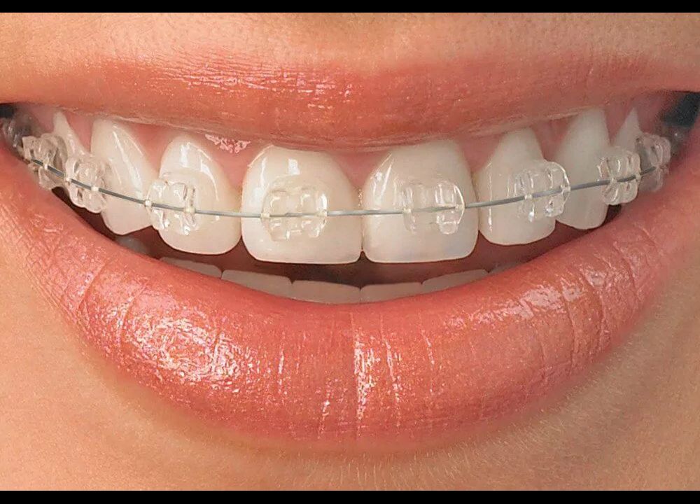  Ceramic Braces