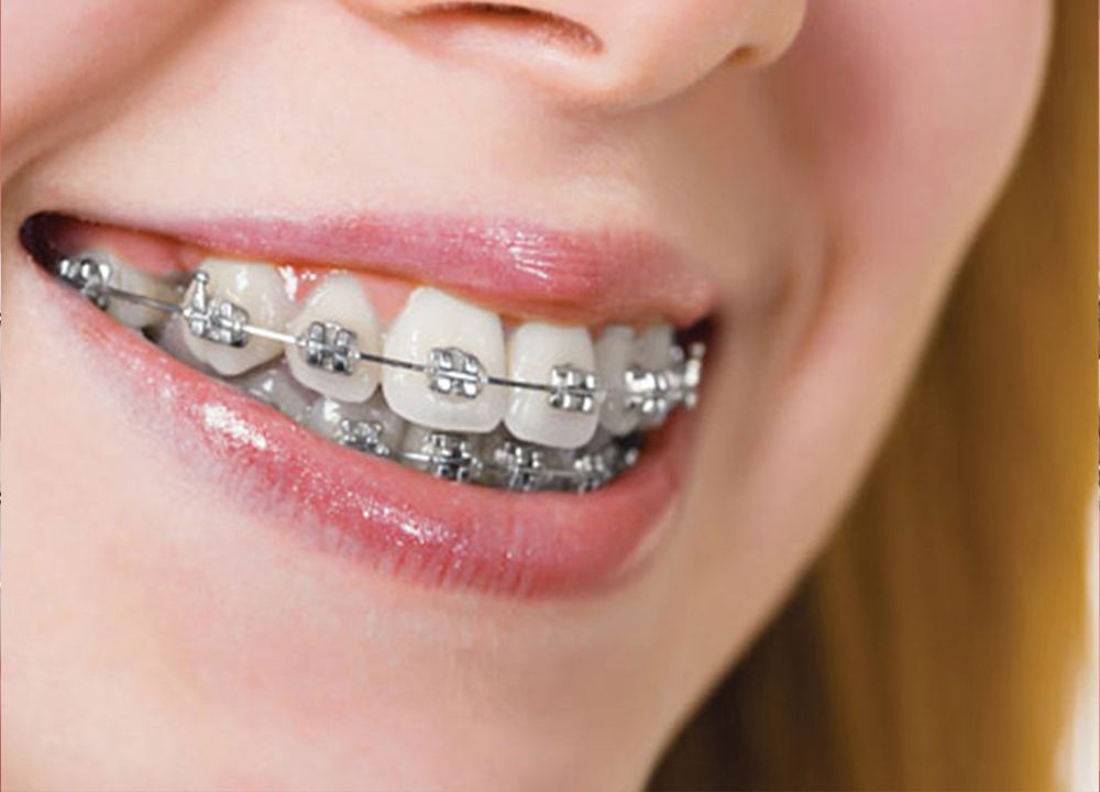 Metal Braces